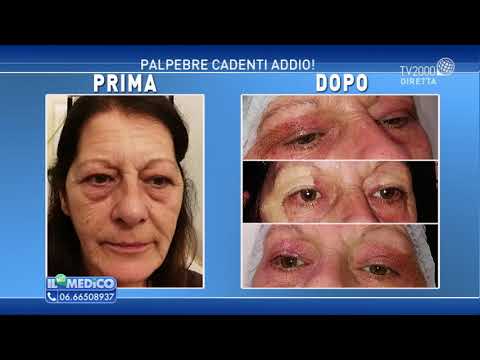 Costo di operazioni laser approssimativamente Molecola gialuronovy stucco di rughe intorno a occhi