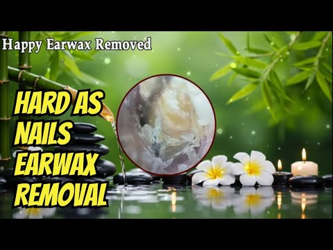 Hard as Nails Earwax Removal, Very Thick Ear Cleaning #earwax #earcleaning #asmr #043