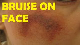 how to get rid of bruises fast and easy on face
