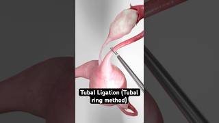 Elastic Birth Control (3D Animation)