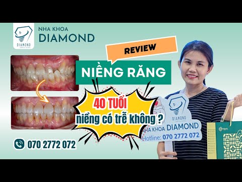 Ms. Mai reviews self-ligating (self-closing) metal braces - It's never too late to get braces at any age!