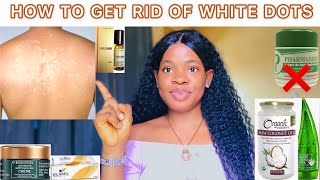 HOW TO GET RID OF WHITE DOTS : Cure For White Spots | White Patches On Skin Home Remedies