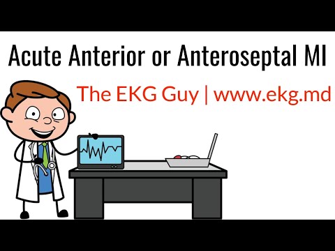 Acute Anterior or Anteroseptal MI on EKG / ECG l The EKG Guy - www.ekg.md