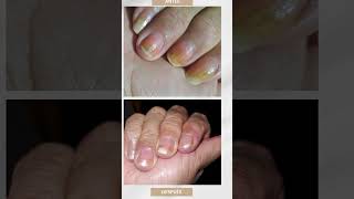 #argentina #skincare #dolordepies #tips #hongos #belleza #hongosenlasuñas #natural #cuidadodelapiel