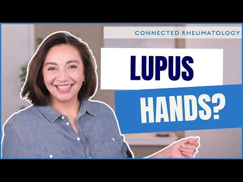 The 3 ways Lupus can affect your hands - a Rheumatologist explains