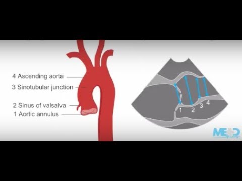 aorta hipertónia magas vérnyomás vizsgálati standardjai