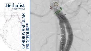 Download Lagu Endovascular Repair (EVAR) of Abdominal Aortic Aneurysm (M. Rahimi, MD, M. Zubair, MD, L. Gomez, MD) Thumbnail