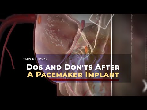 Dos and Don'ts After A Pacemaker Implant