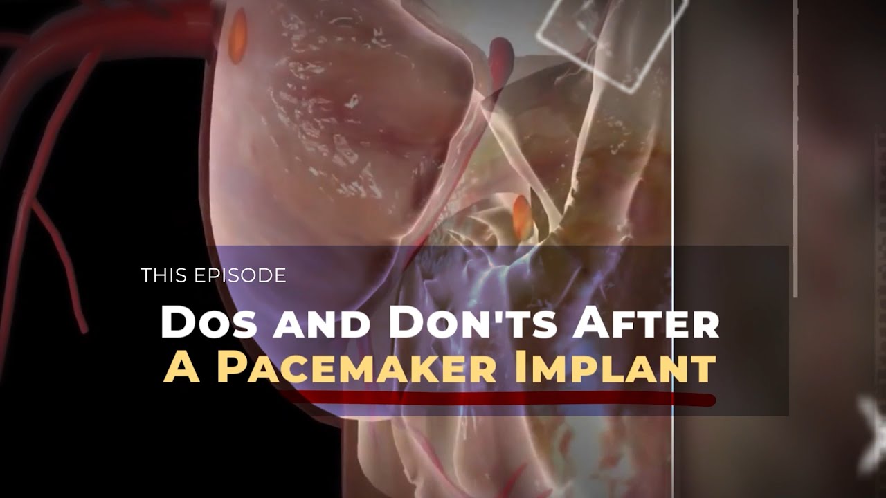Dos and Don'ts After A Pacemaker Implant