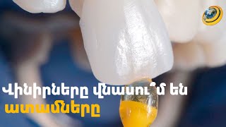 Արդյո՞ք վինիրները վնասում են ատամները