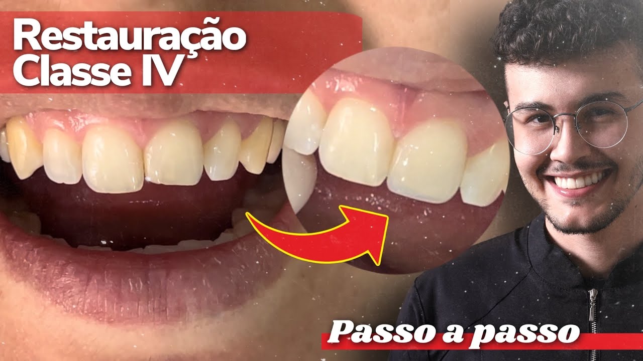 Restauração Classe IV - Resina Composta [TUTORIAL] Lucas Venâncio