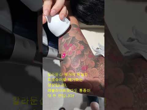 이레즈미 문신 제거 치료 안내 1