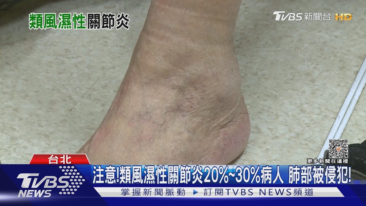 罹「這疾病」小心肺部纖維化 拖延病情死亡風險高!