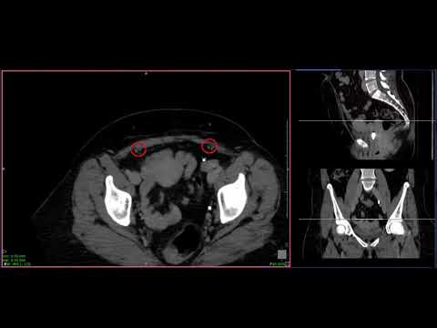 Anatomia tomográfica da pelve feminina