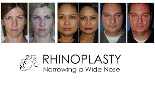 Rhinoplasty - How can a wide nose be narrowed