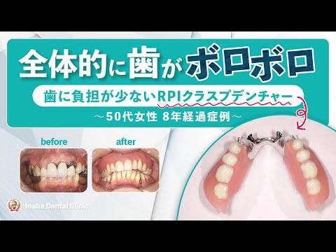 全体的に歯がボロボロ 歯に負担の少ないRPIクラスプデンチャー〜50代女性8年経過症例〜