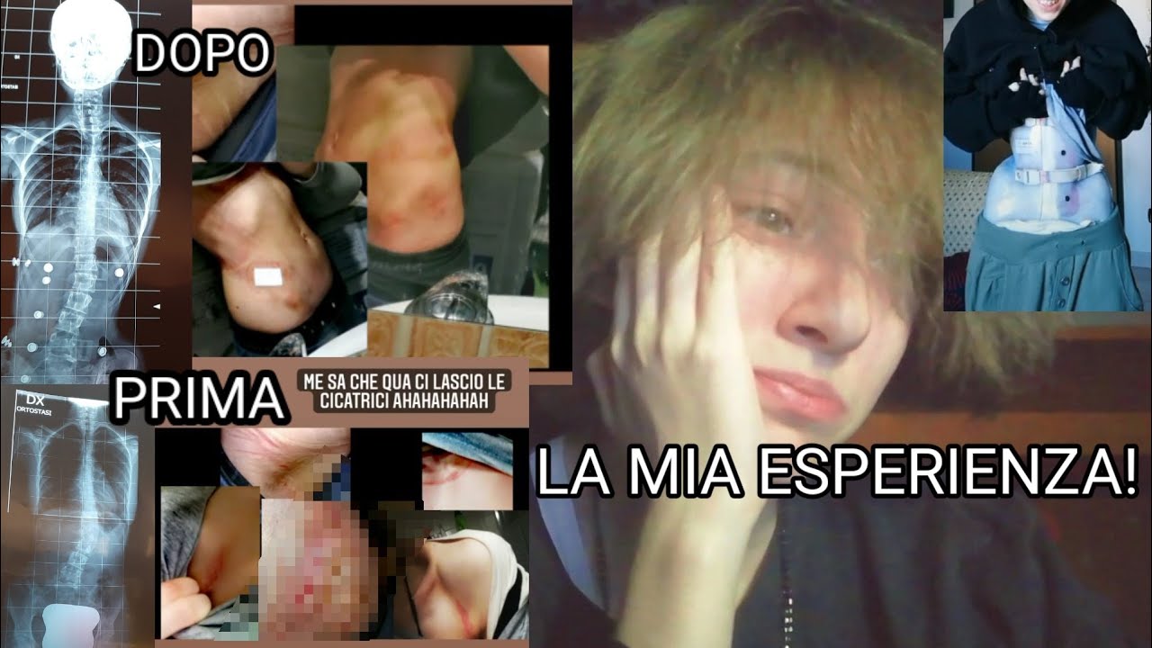 LA MIA ESPERIENZA CON IL BUSTO ORTOPEDICO! (scoliosi lombare 23 gradi)