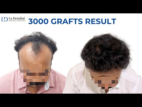 Best Hair Transplant in Bangalore || Best Hair...