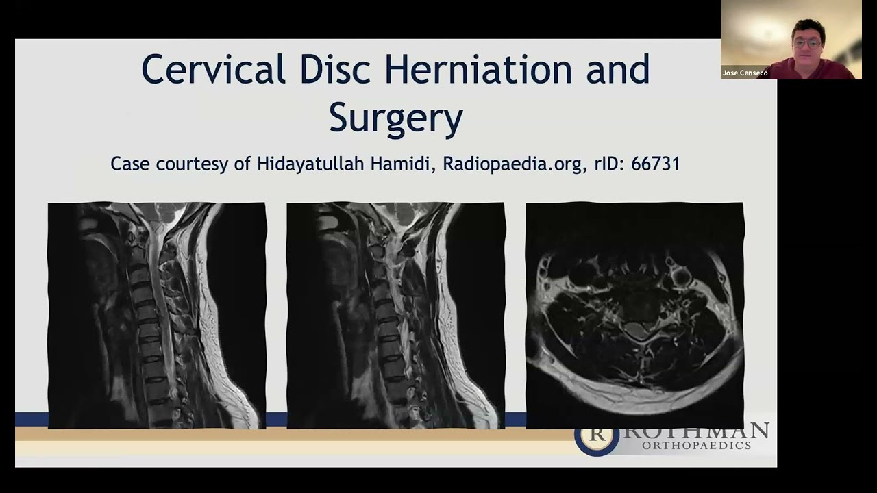 Cervical Spine disease: When is Surgery the Right Decision?