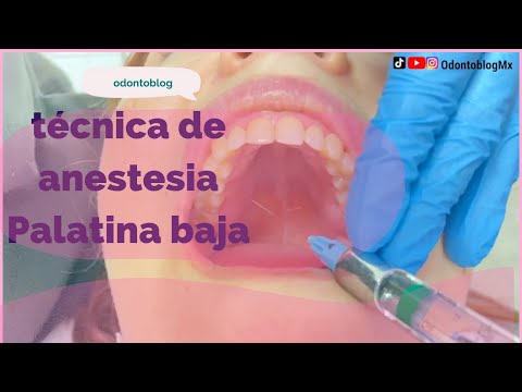 Técnica Palatina Baja