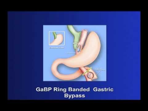 GaBP Ring™ Why the Banded Gastric Bypass