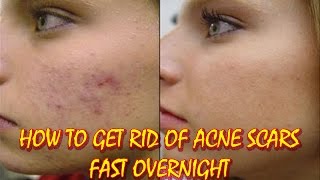 How to Get Rid of Acne Scars Fast Overnight | An easy way to get rid of acne scars fast -- HOW TO