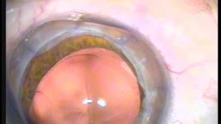 Download Lagu triple procedure: PK, open-sky cataract extraction and IOL implantation by A. John Kanellopoulos, MD Thumbnail