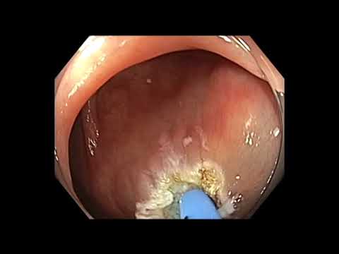 Colonoscopia: RME colon ascendente - engrosamiento de la mucosa - adenoma serrado sésil (ASS).