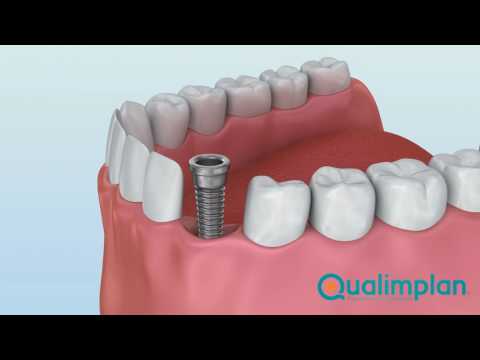 Procedimento de Implante Dentário - Demonstração 3D
