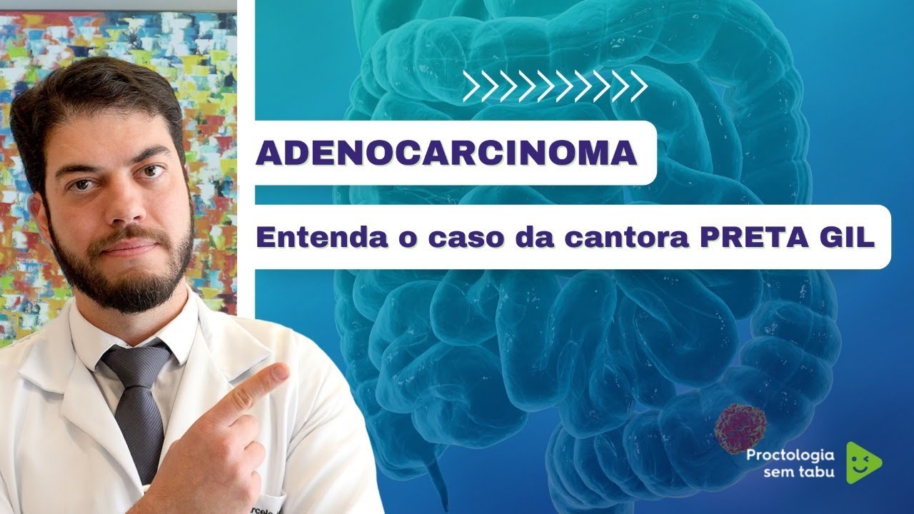 Entenda o caso da cantora Preta Gil. Adenocarcinoma de cólon. Câncer de intestino