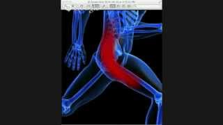 preview picture of video 'New Orleans Sciatica Chiropractor | Metairie Sciatic Treatment Doctor'