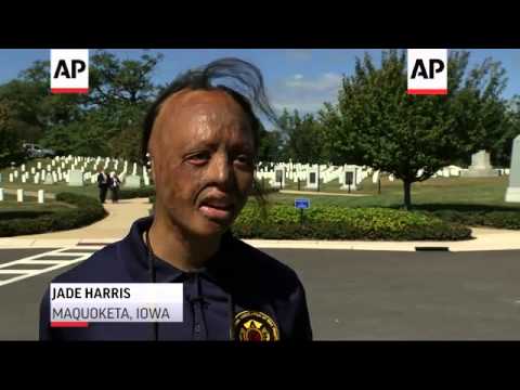 About 50 child burn survivors from across the U.S. and Canada have gathered in Washington for "Inter