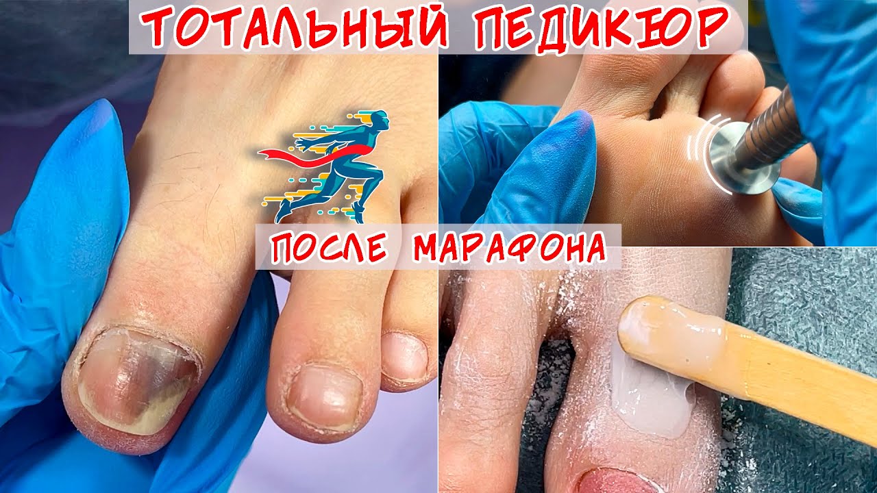 Полный педикюр / Онихолизис ногтей и синяк под ногтем