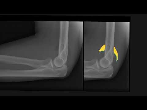 Elbow effusion on X-ray