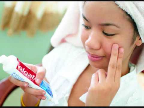 download lagu mp3 mp4 Cara Untuk Menghilangkan Jerawat Menggunakan Ubat Gigi, download lagu Cara Untuk Menghilangkan Jerawat Menggunakan Ubat Gigi gratis, unduh video klip Cara Untuk Menghilangkan Jerawat Menggunakan Ubat Gigi