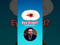 Why Is Your Eye Bleeding? The Truth About Subconjunctival Hemorrhage