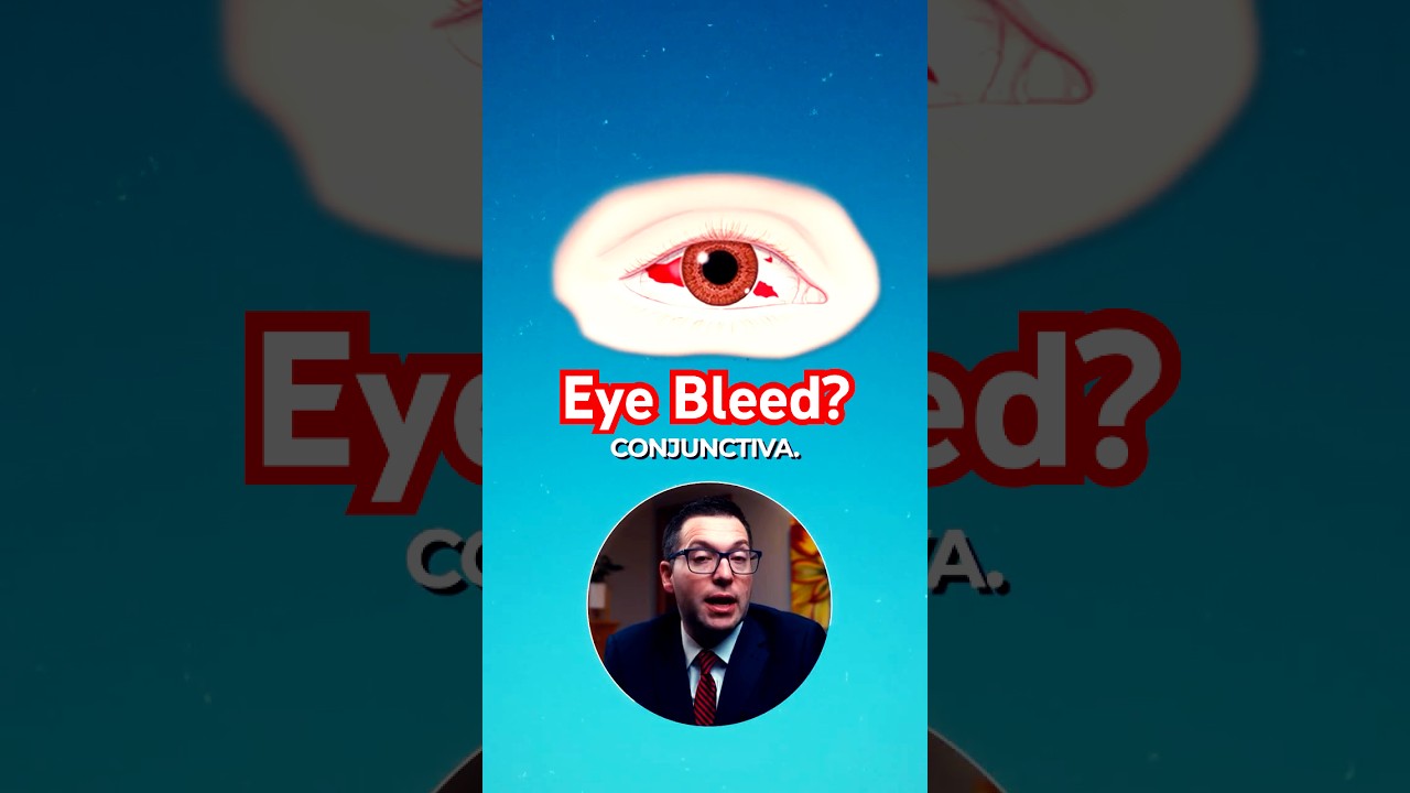 Why Is Your Eye Bleeding? The Truth About Subconjunctival Hemorrhage