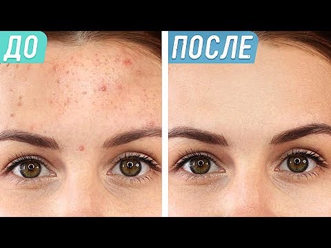 Мазь крем от пигментных пятен отзывы Отбеливающие кремы от веснушек и пигментных пятен