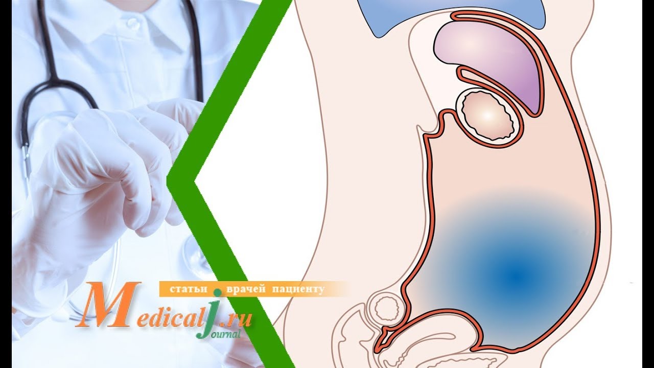 Асцит. Какие причины Какие симптомы Как лечить