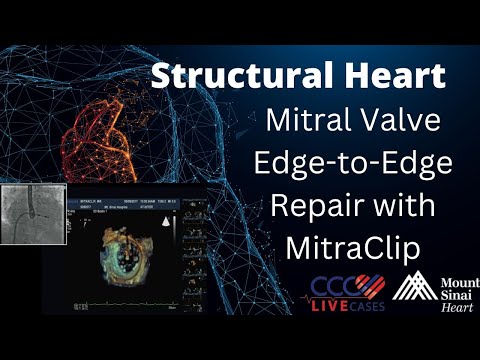 Transfemoral TAVR Evolut-R (29 mm) via Percutaneous Femoral Access - Structural Live March 2017
