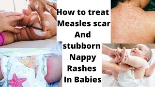 How To Make Nappy Rash Cream And Treatment For Measles Scar Body Spot / Treat Diaper Rash FAST