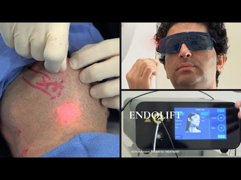Endolift Laser Treatment, Orange County, CA PCH MedSpa