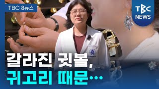 [TBC 닥터리포트] 갈라진 귓볼, 귀고리 때문....