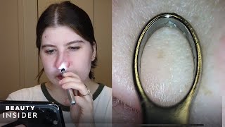 Blackhead-Removing Loop Has Built-In Microscope | The Zit Fix | Beauty Insider