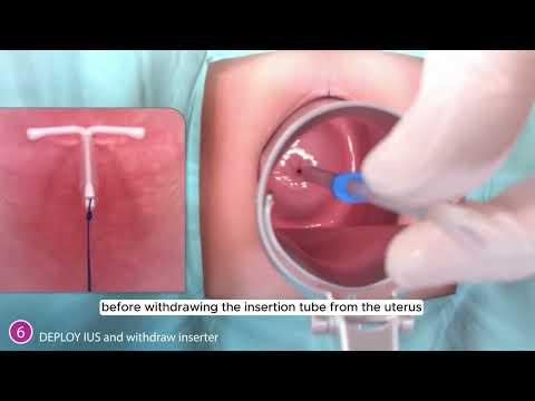 Inserting AVIBELA hormonal IUD (English)
