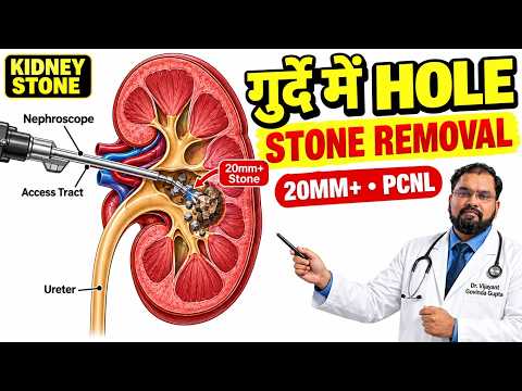 PCNL Kidney Stone Treatment | बड़ी पथरी कैसे निकलती है?