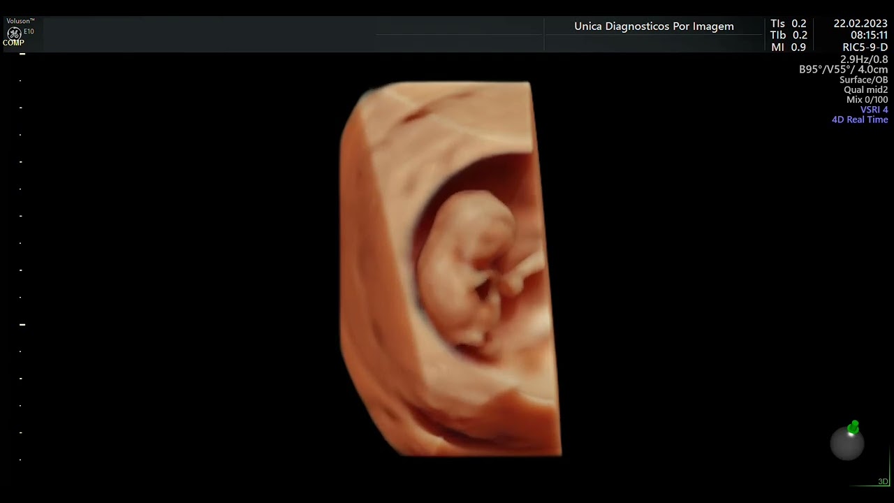 Ultrassom 4D HD LIVE ou Ultrassom 5D - 3