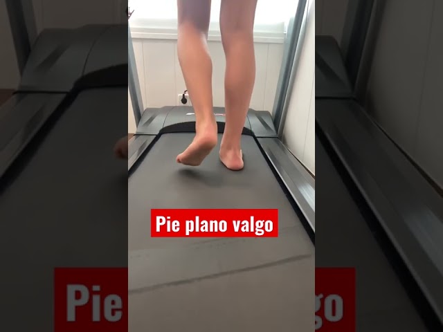 Vídeo relacionado con Corrección de pies planos