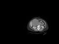 Abdominal Cyst CT