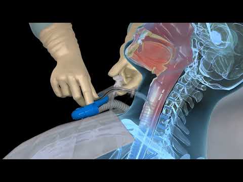 Open Suctioning with a Tracheostomy Tube - 3D animation